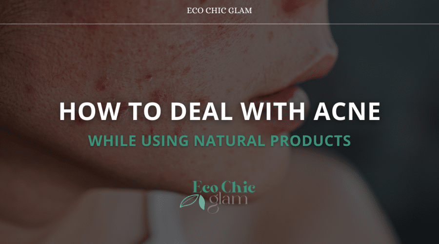 How to Deal with Acne While Using Natural Products